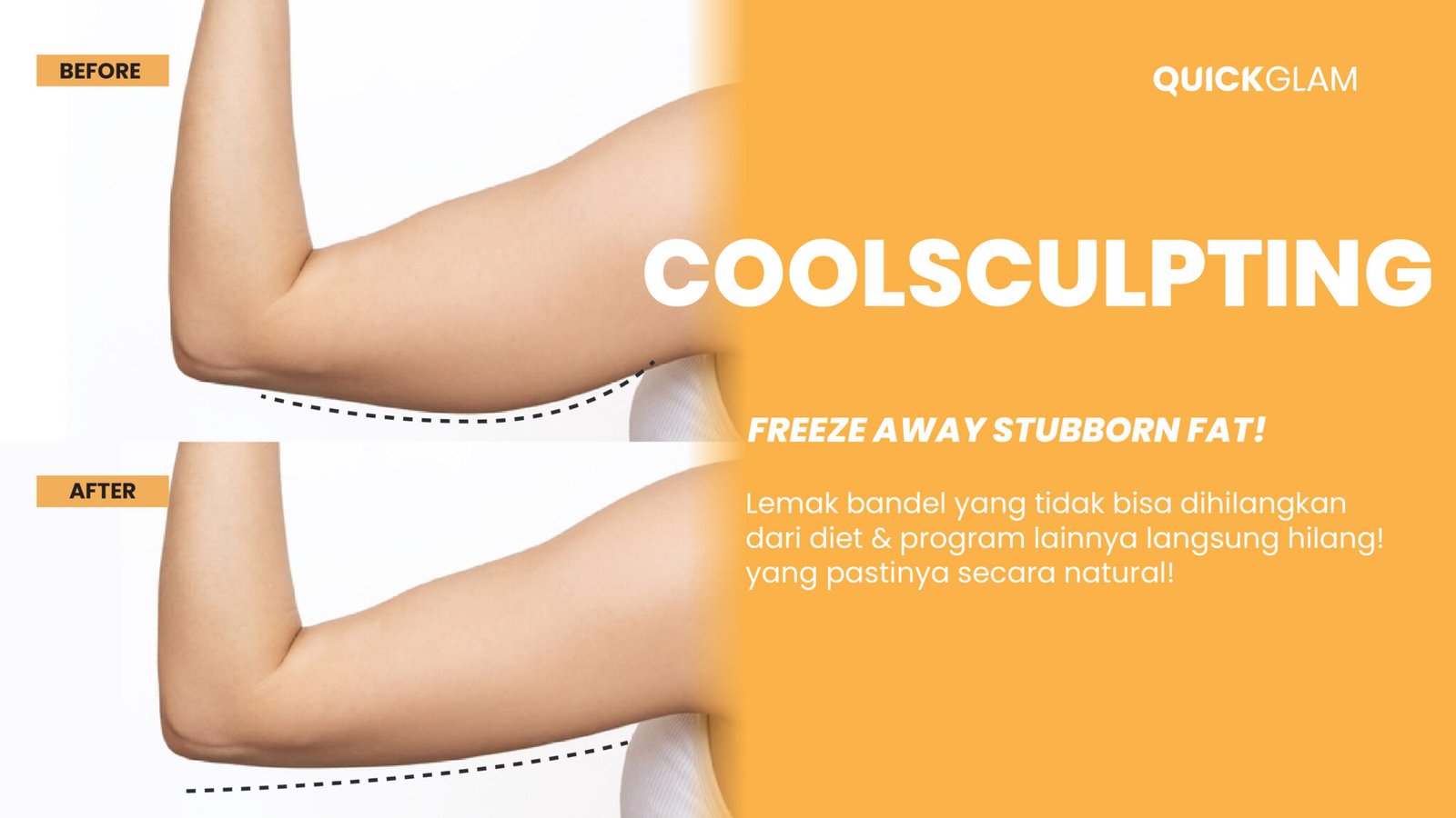 coolsculpting